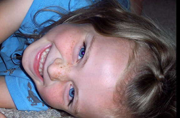 Freckles