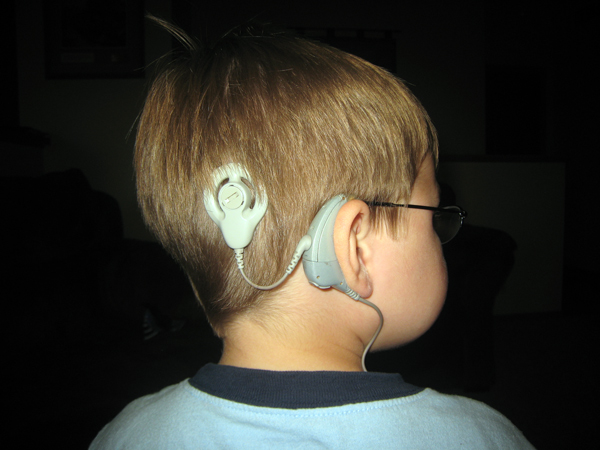 cochlear-implants-web